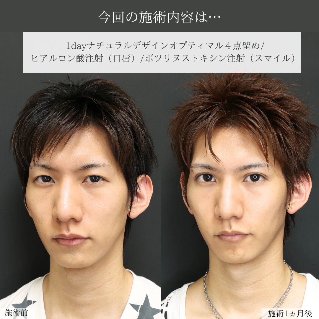 二重埋没法/ヒアルロン酸注射：その他/ボトックス注射：その他の症例写真 施術前後 
