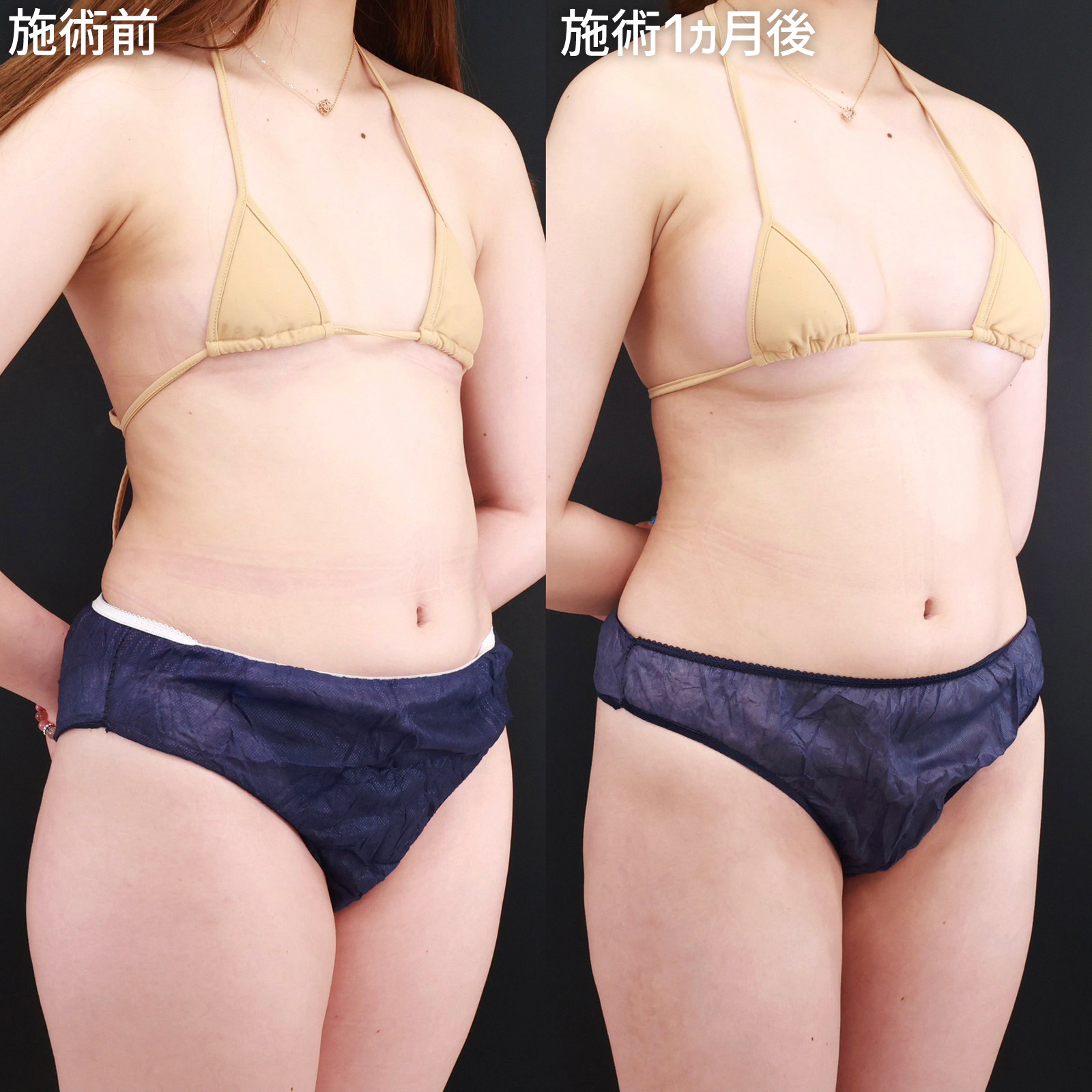 体の脂肪吸引/シリコンバッグ豊胸（人工乳腺バッグ）の症例写真 施術前後 