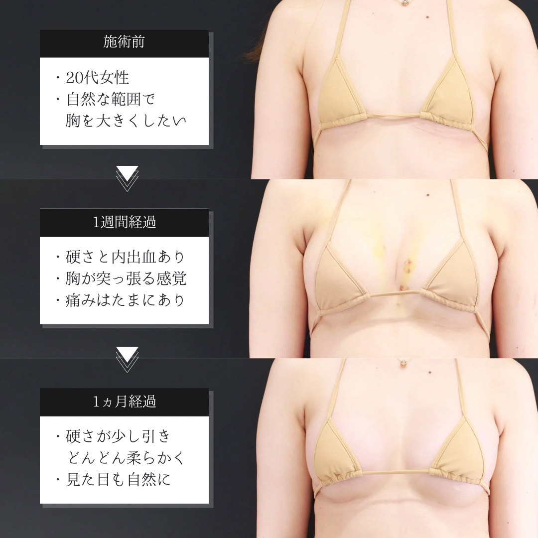体の脂肪吸引/シリコンバッグ豊胸（人工乳腺バッグ）の症例写真 施術前後 