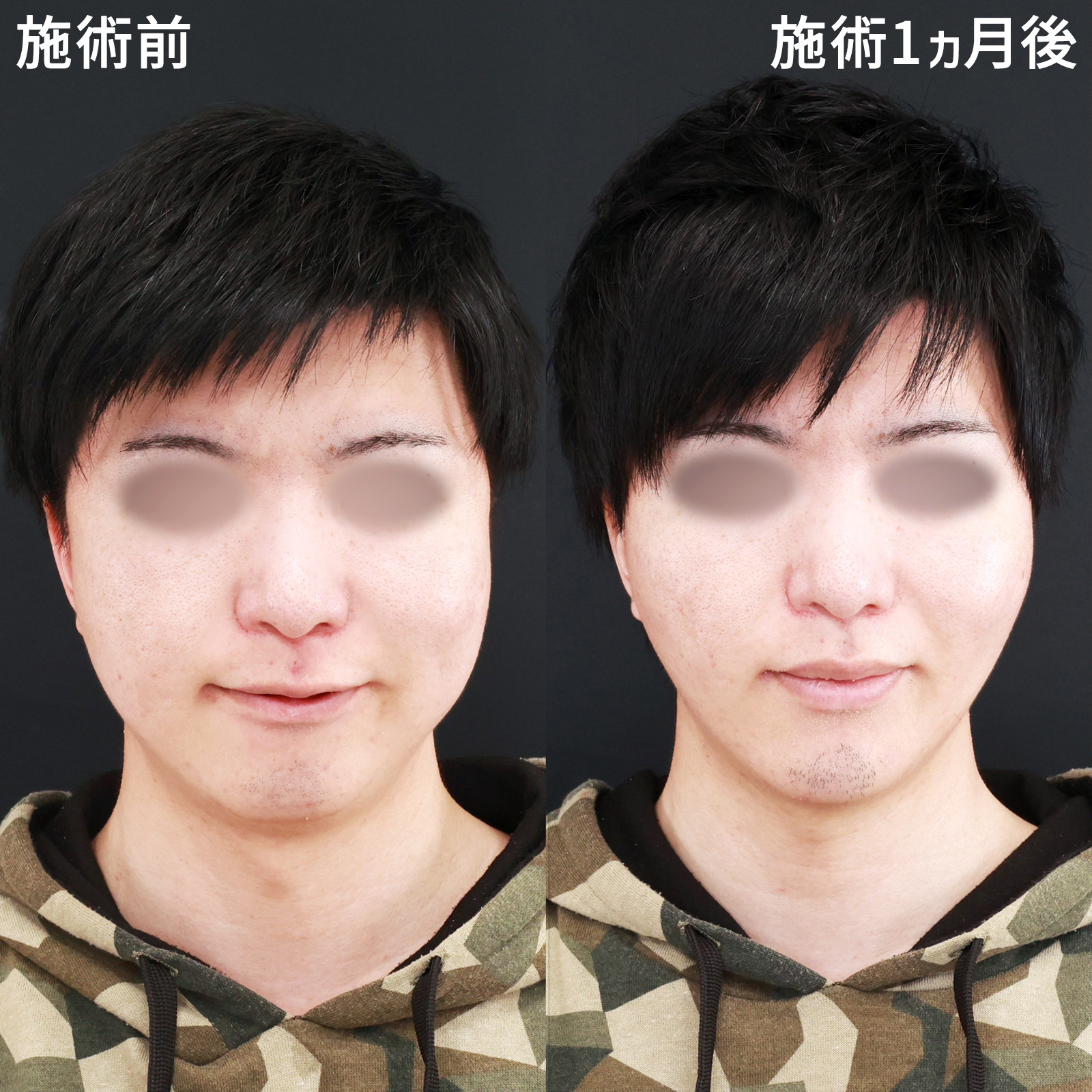 TAC式 ツヤ肌コラーゲンリフト®/バッカルファット除去/ジョールファット除去の症例写真 施術前後 