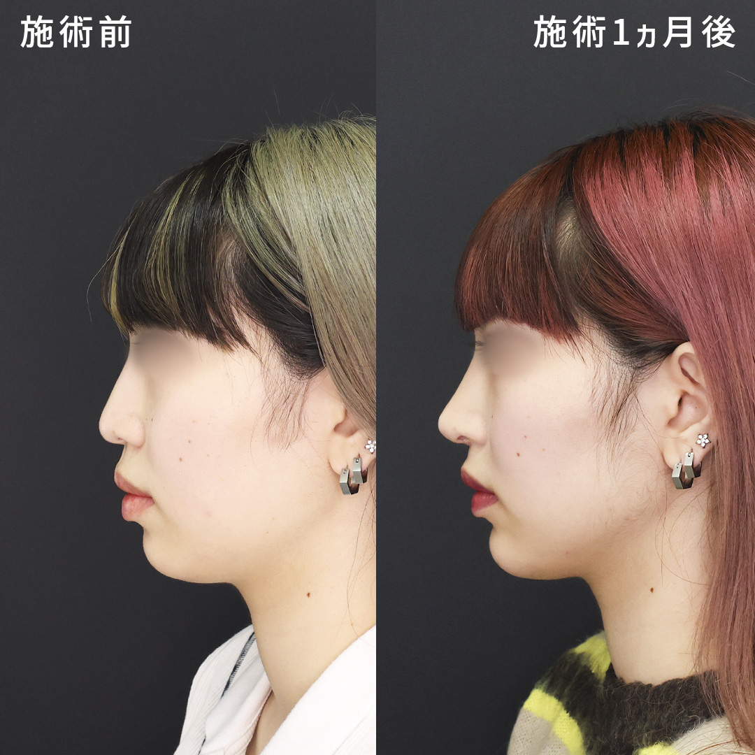 鼻中隔延長術/鼻尖形成・鼻尖縮小/鼻先軟骨移植の症例写真 施術前後 