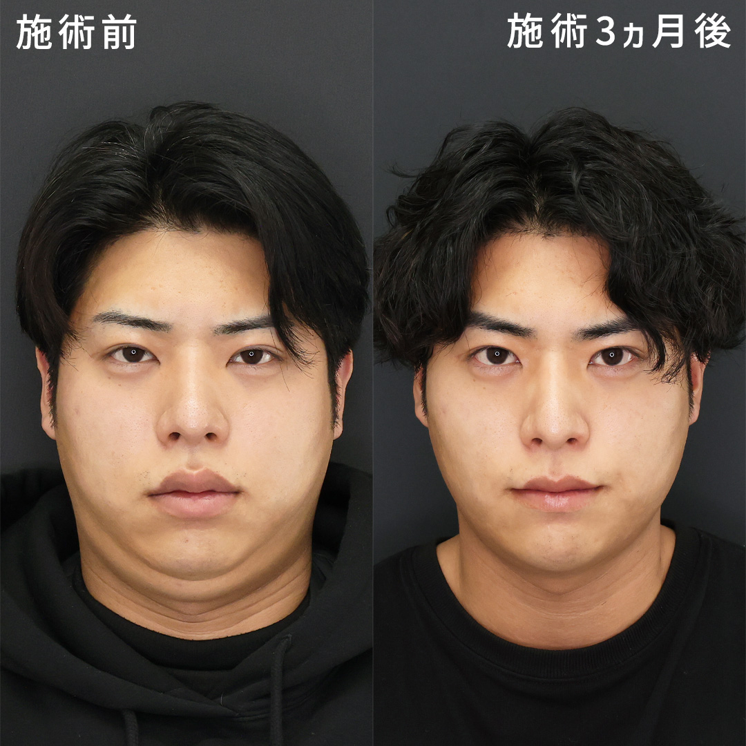 垢抜けイケメン爆誕｜形成外科専門医が行うオーダーメイド小顔術×口唇縮小