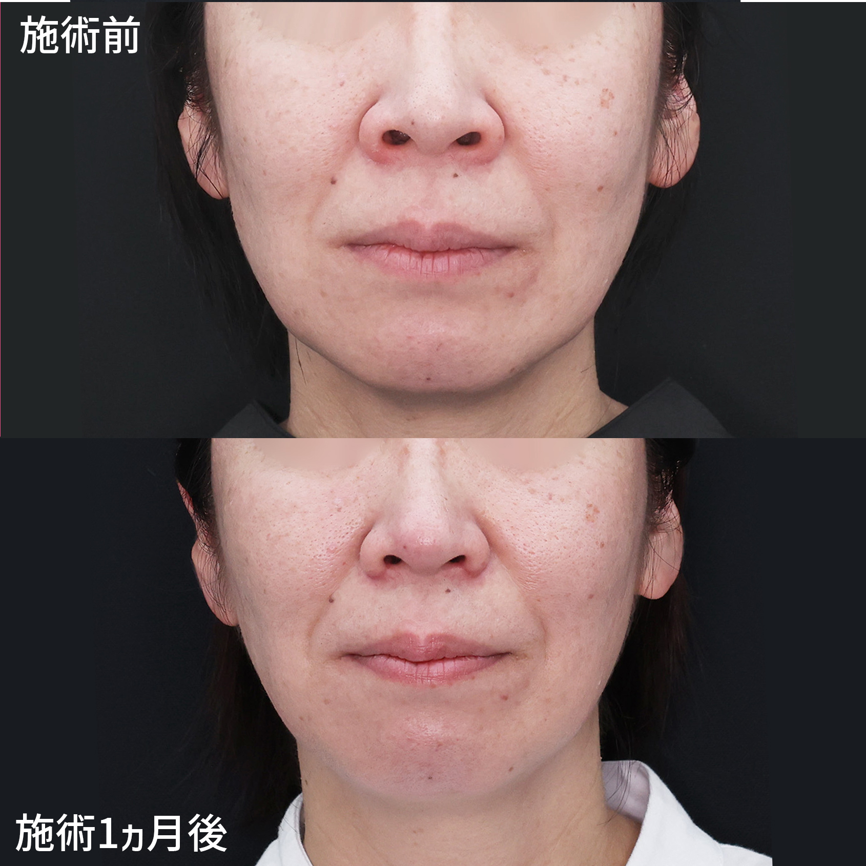 鼻翼挙上術/鼻尖4Dノーズ/TAC式 鼻翼縮小術（小鼻縮小）の症例写真 施術前後 