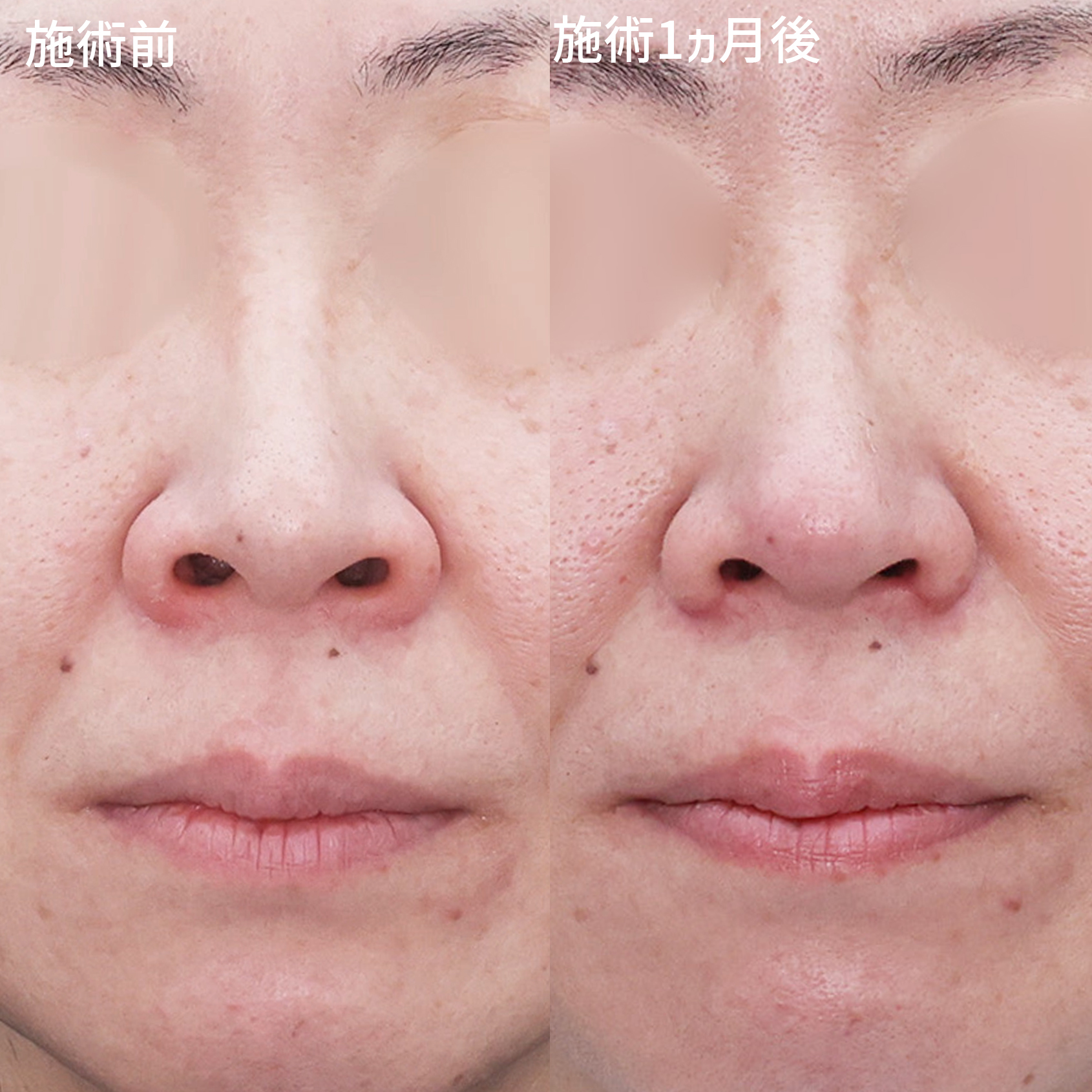 鼻翼挙上術/鼻尖4Dノーズ/TAC式 鼻翼縮小術（小鼻縮小）の症例写真 施術前後 