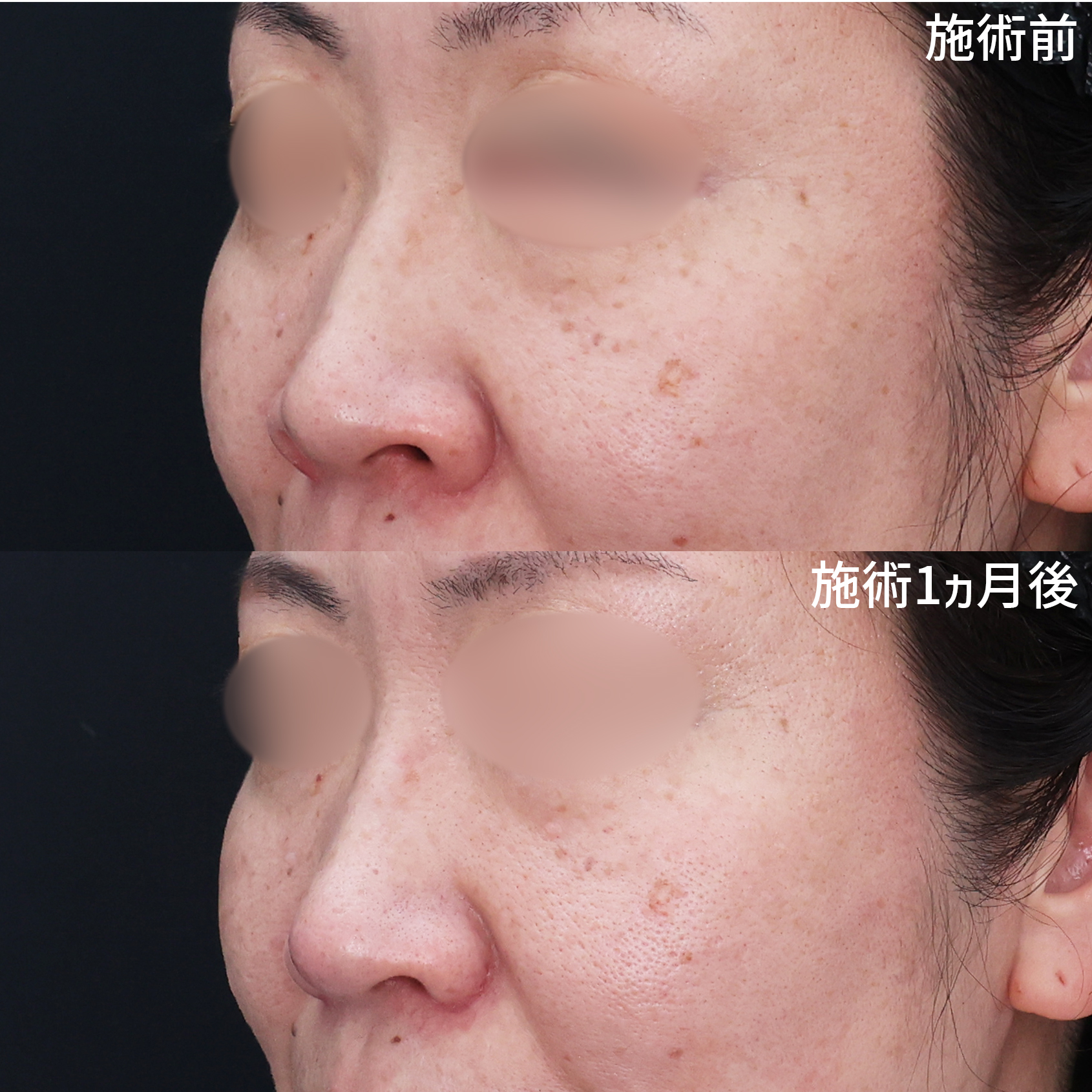 鼻翼挙上術/鼻尖4Dノーズ/TAC式 鼻翼縮小術（小鼻縮小）の症例写真 施術前後 