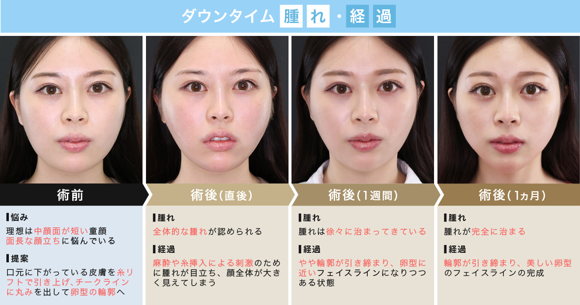 糸リフトのダウンタイムは？