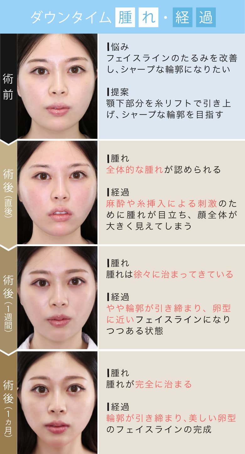 糸リフトのダウンタイムは？