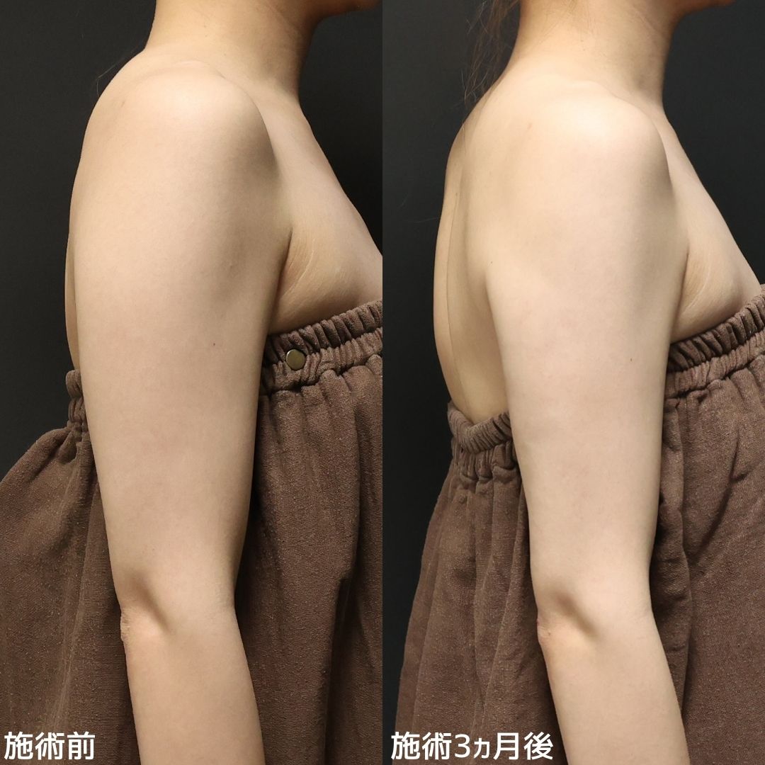 体の脂肪吸引の症例写真 施術前後 