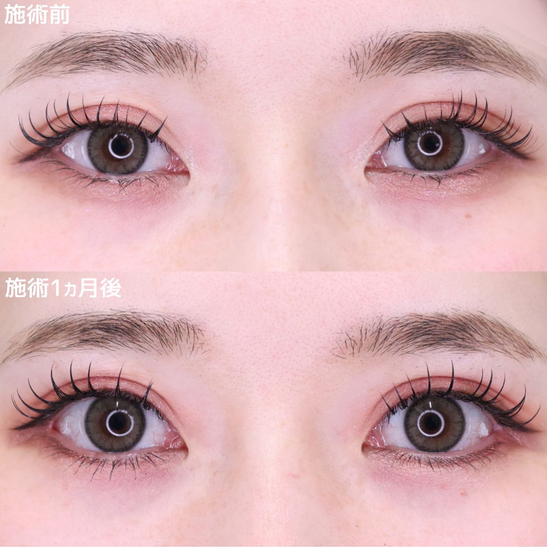 グラマラスライン（タレ目形成）/目尻切開術の症例写真 施術前後 