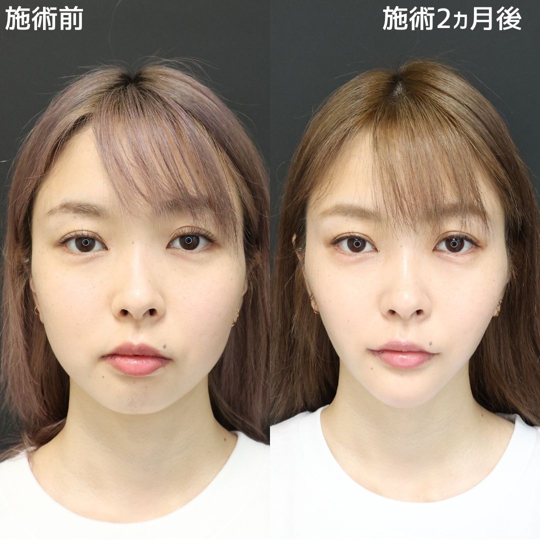 バッカルファット除去/ジョールファット除去/TAC式 ツヤ肌コラーゲンリフト®の症例写真 施術前後 