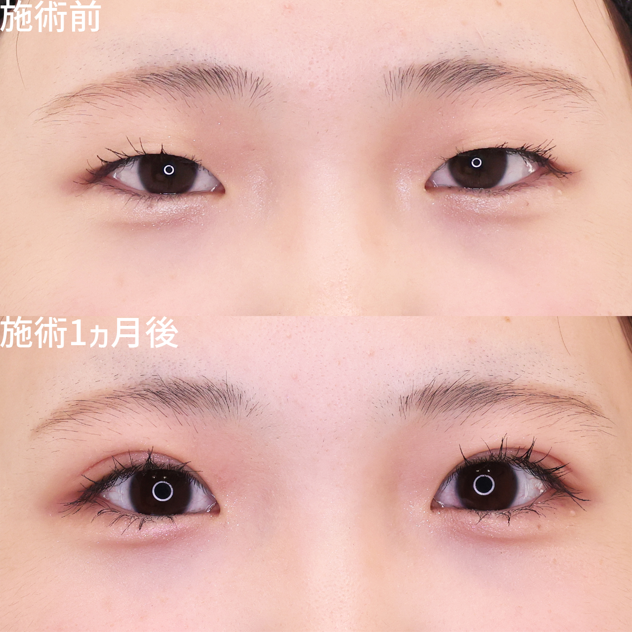 二重埋没法の症例写真 施術前後 