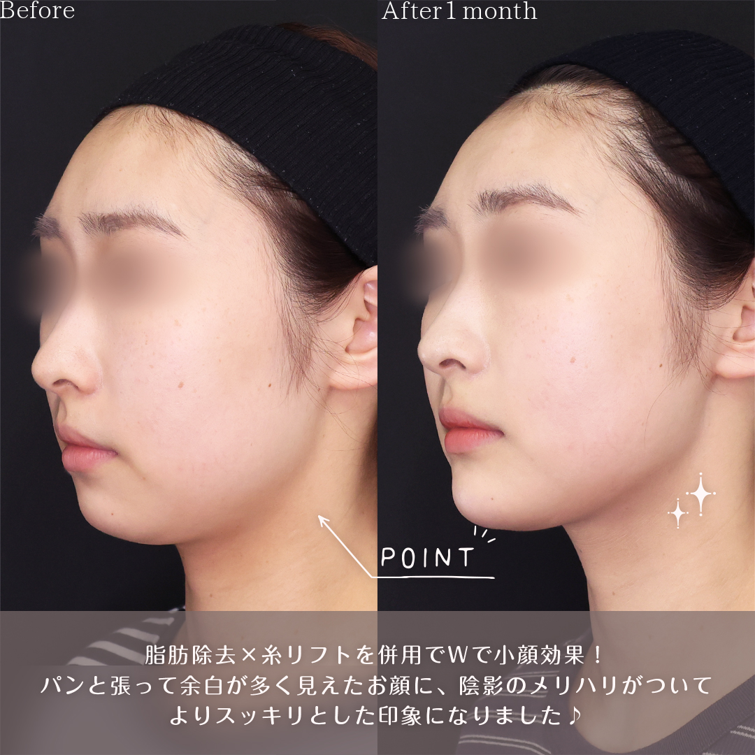 小顔整形｜パーフェクトフェイスライン/TAC式 ツヤ肌コラーゲンリフト®/Lラインファット除去（エラ下脂肪除去）の症例写真 施術前後 