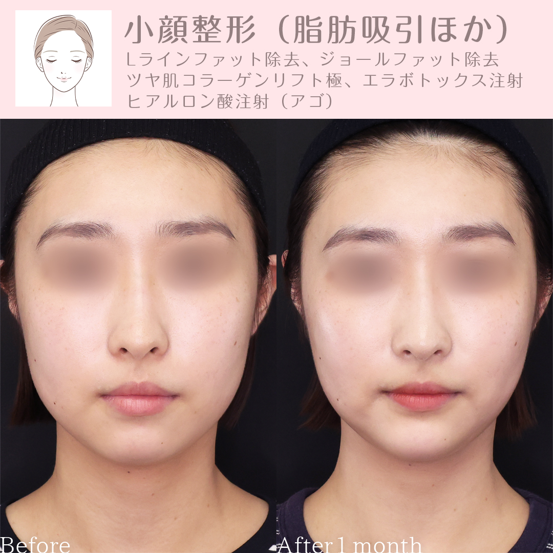 小顔整形｜パーフェクトフェイスライン/TAC式 ツヤ肌コラーゲンリフト®/Lラインファット除去（エラ下脂肪除去）の症例写真 施術前後 