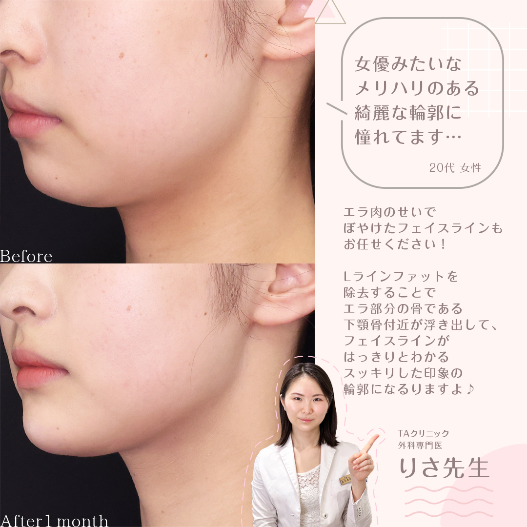 小顔整形｜パーフェクトフェイスライン/TAC式 ツヤ肌コラーゲンリフト®/Lラインファット除去（エラ下脂肪除去）の症例写真 施術前後 