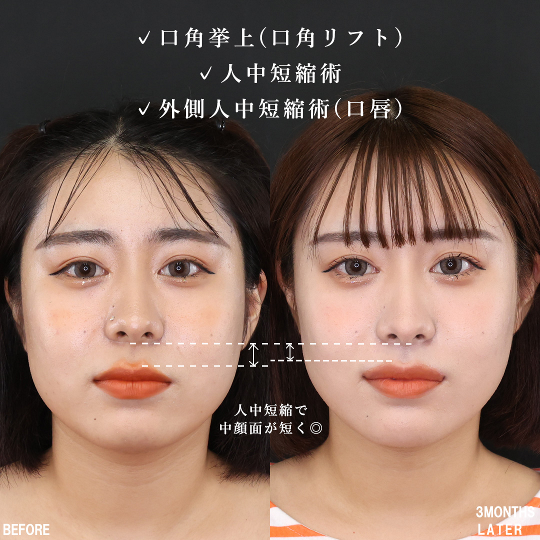 口角挙上・リフト（マイクロ切開法・内側法/口内法）/人中短縮術(リップリフト)・外側人中短縮術の症例写真 施術前後 