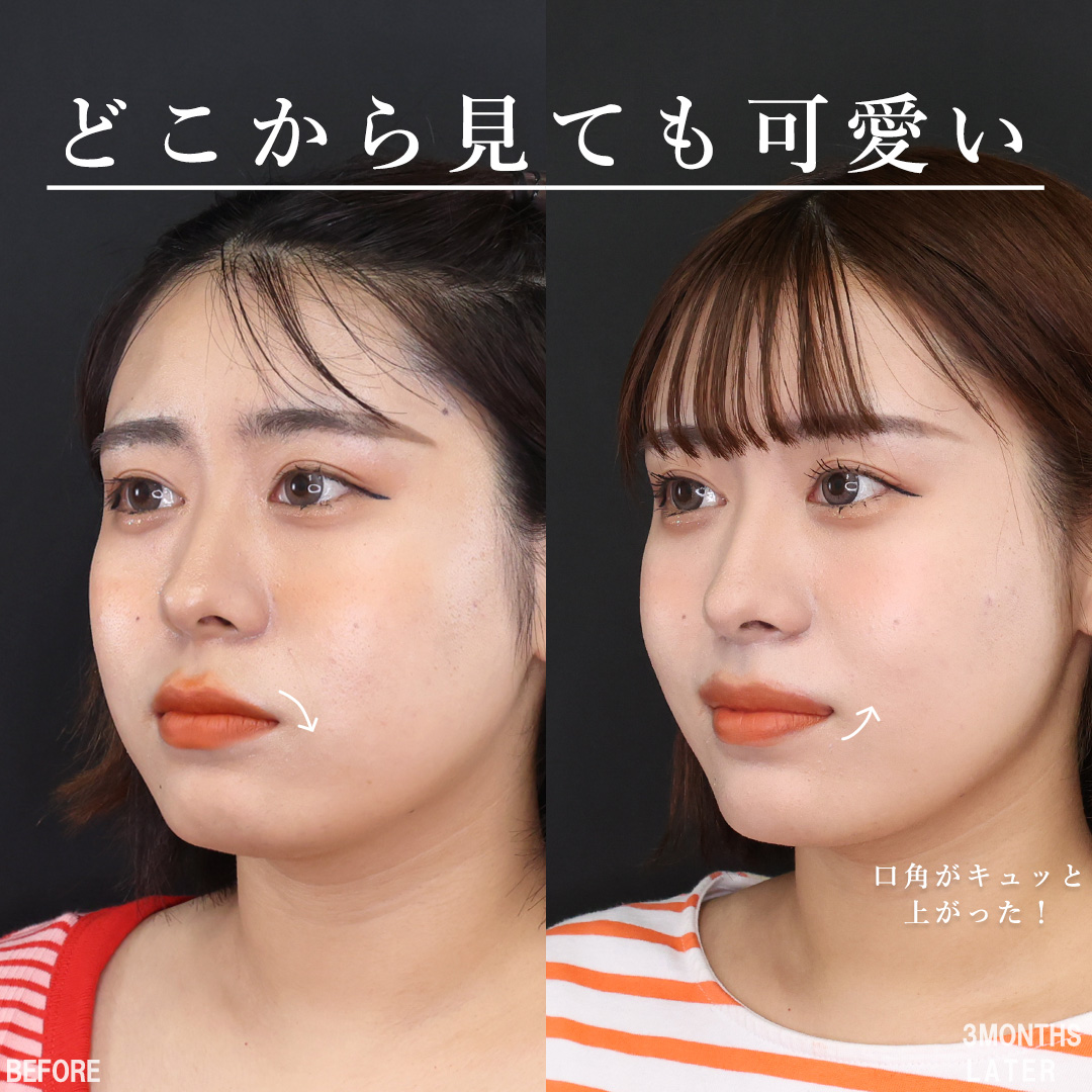 口角挙上・リフト（マイクロ切開法・内側法/口内法）/人中短縮術(リップリフト)・外側人中短縮術の症例写真 施術前後 