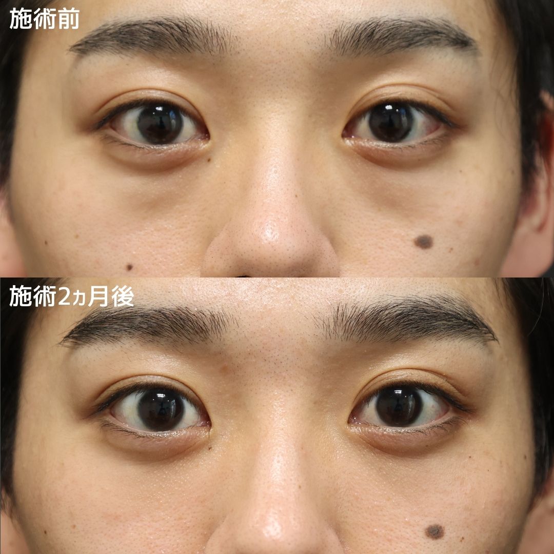 下眼瞼脱脂術（目の下のたるみ取り・目の下の脂肪ふくらみ取り）の症例写真 施術前後 