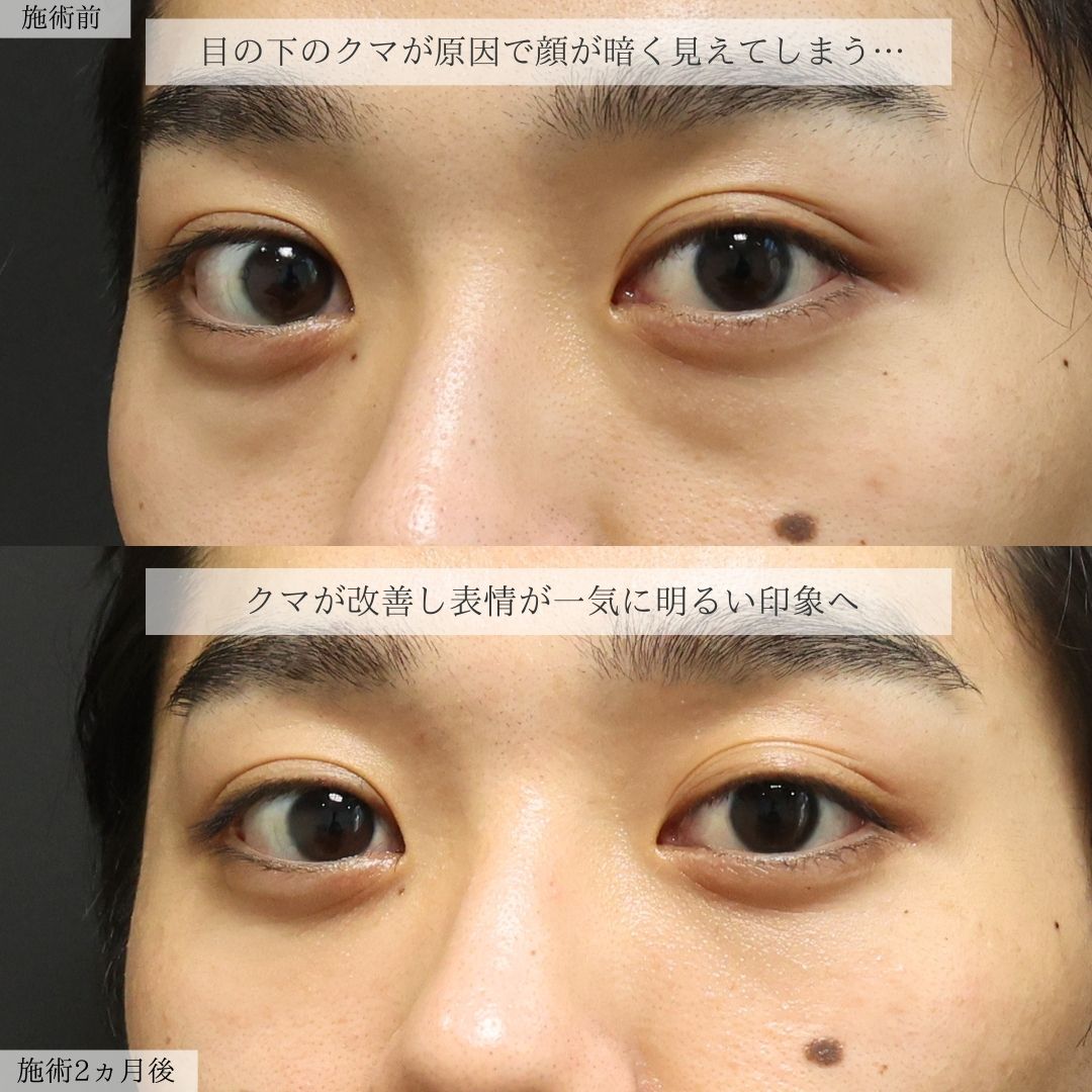 下眼瞼脱脂術（目の下のたるみ取り・目の下の脂肪ふくらみ取り）の症例写真 施術前後 