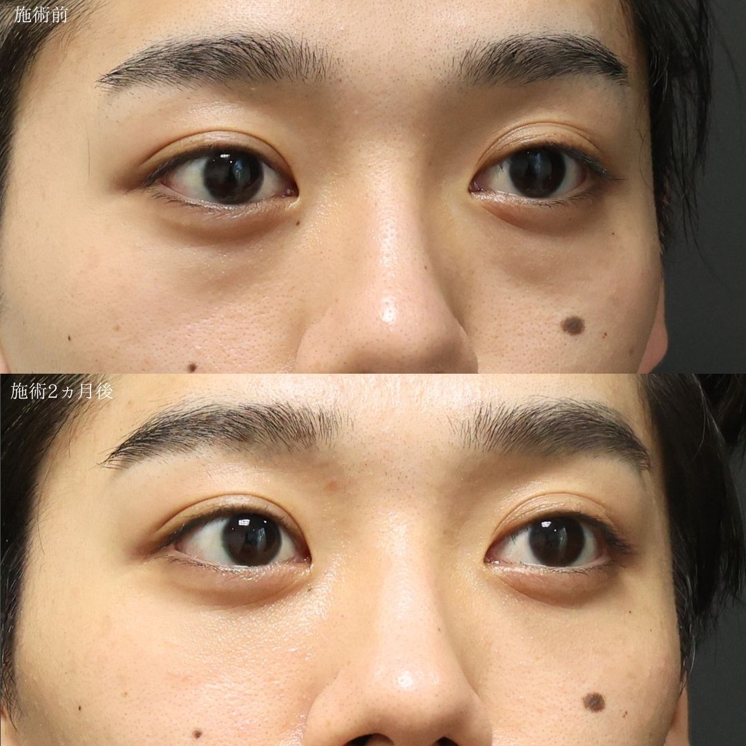 下眼瞼脱脂術（目の下のたるみ取り・目の下の脂肪ふくらみ取り）の症例写真 施術前後 
