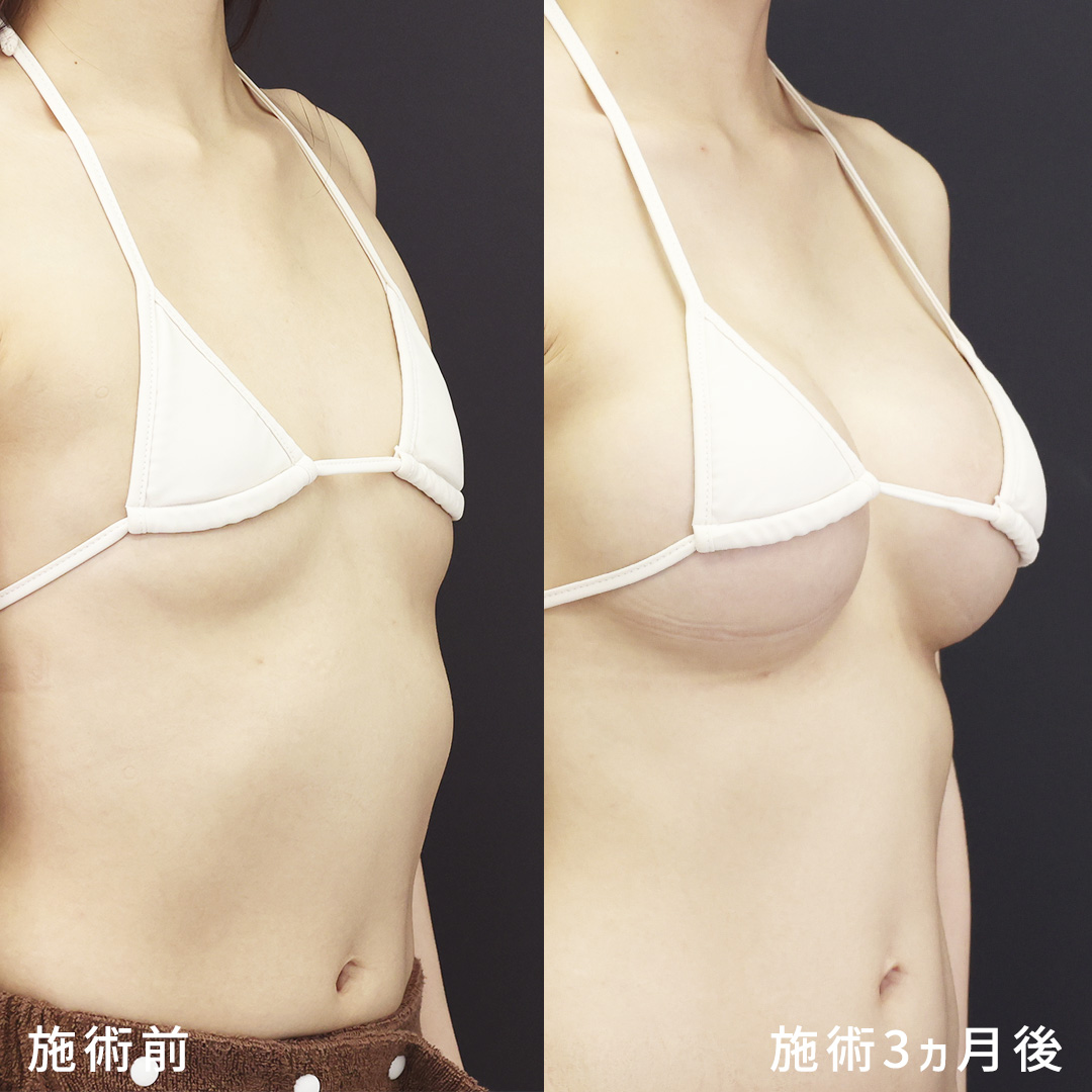 シリコンバッグ豊胸（人工乳腺バッグ）の症例写真 施術前後 