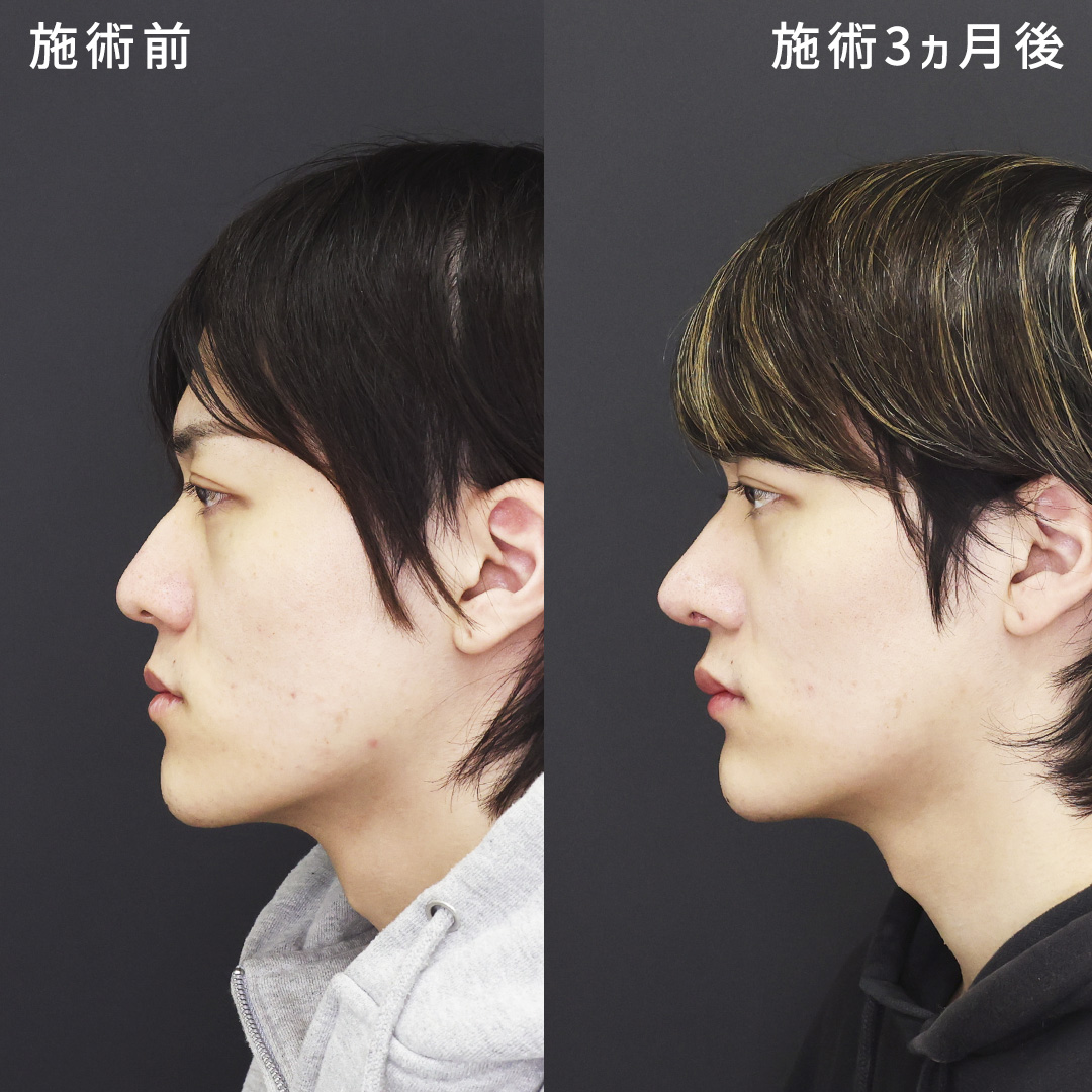 鼻中隔延長術/鼻尖形成・鼻尖縮小/鼻先軟骨移植の症例写真 施術前後 