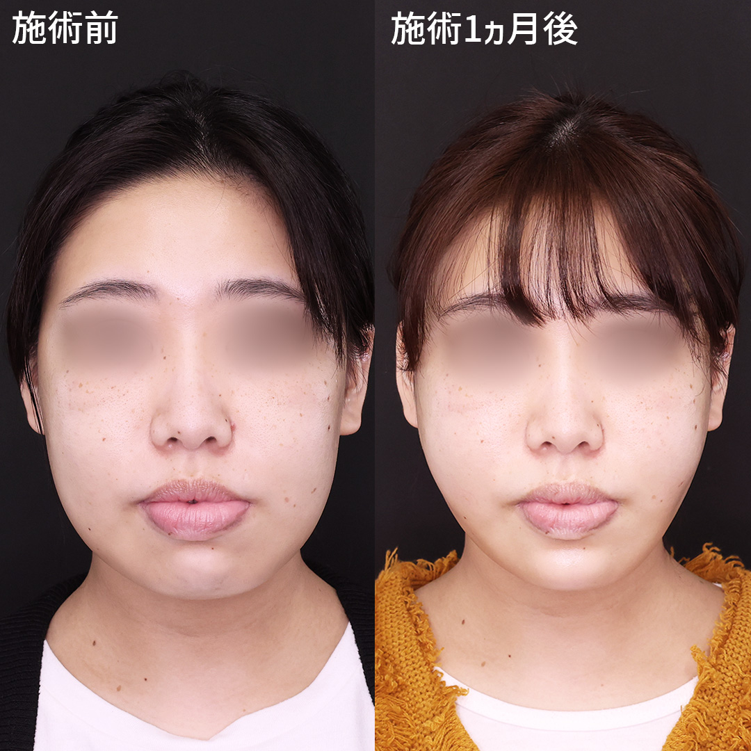 TAC式 ツヤ肌コラーゲンリフト®/エラボトックス注射/ボトックス注射：その他の症例写真 施術前後 