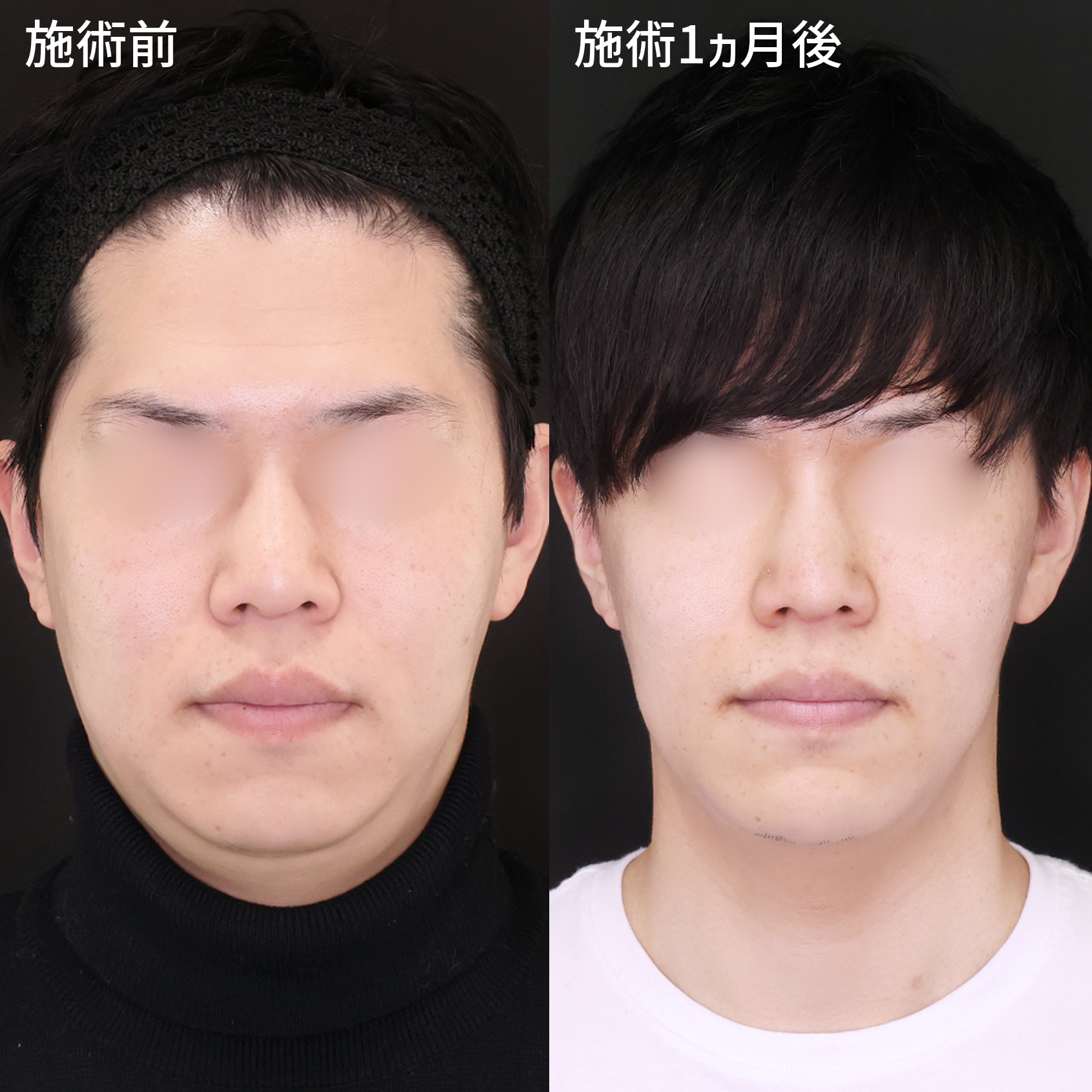 顎下の脂肪吸引/TAC式 ツヤ肌コラーゲンリフト®の症例写真 施術前後 