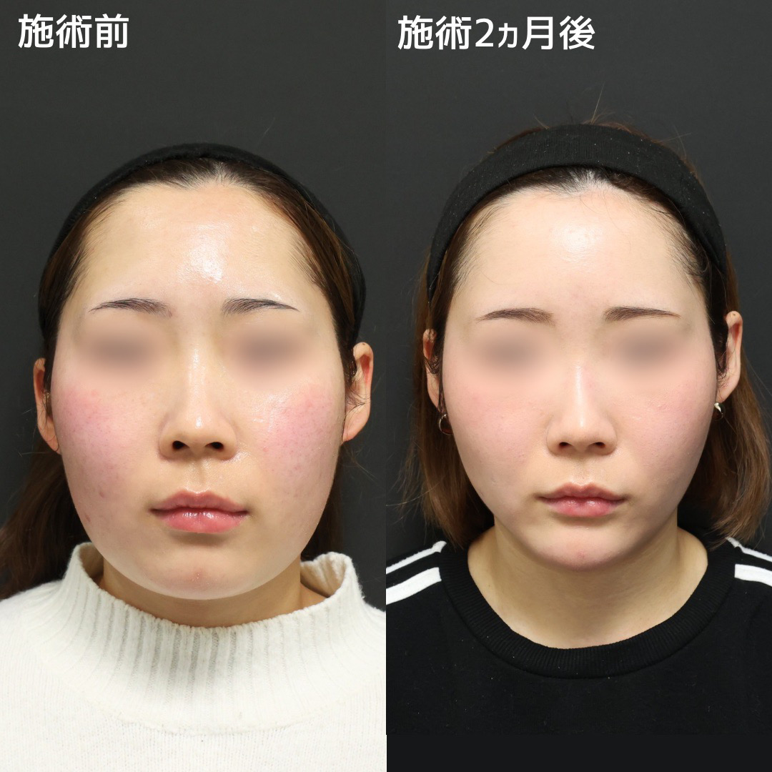 TAC式 ツヤ肌コラーゲンリフト®/ジョールファット除去/Lラインファット除去（エラ下脂肪除去）の症例写真 施術前後 
