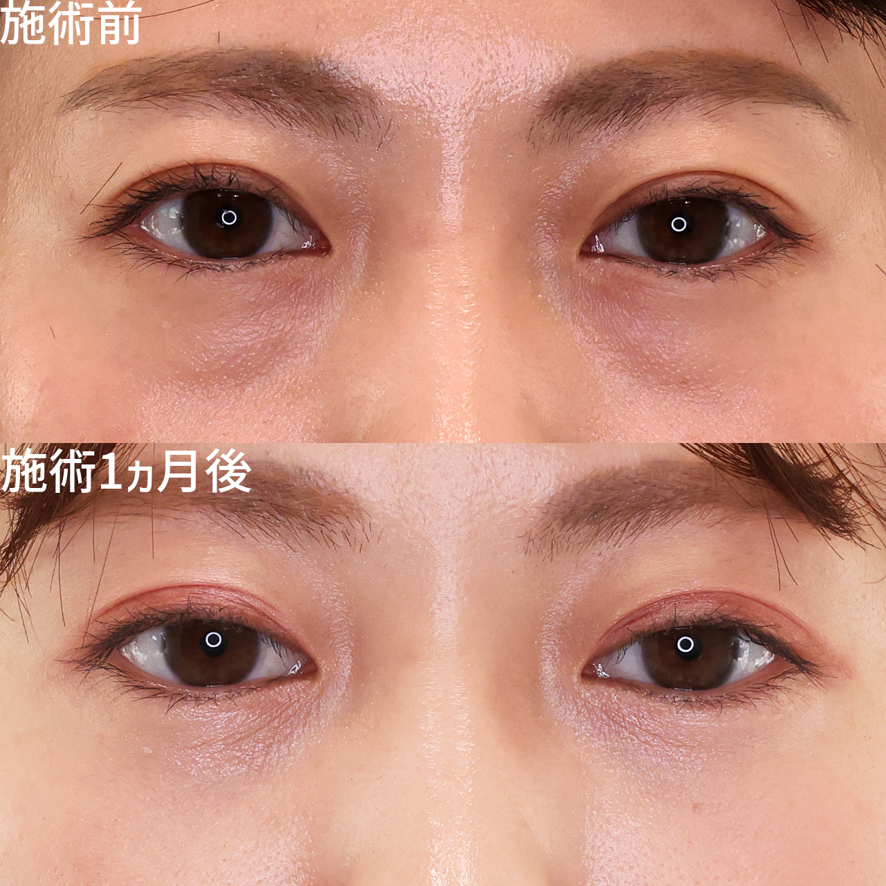 下眼瞼脱脂術（目の下のたるみ取り・目の下の脂肪ふくらみ取り）/顔の脂肪注入(コンデンスリッチフェイス)の症例写真 施術前後 