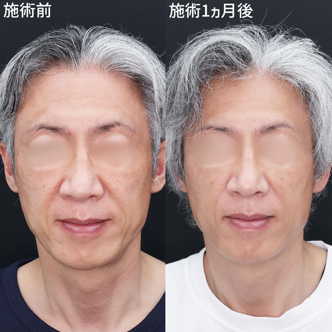 ナゾラビアルファット除去の症例写真 施術前後 