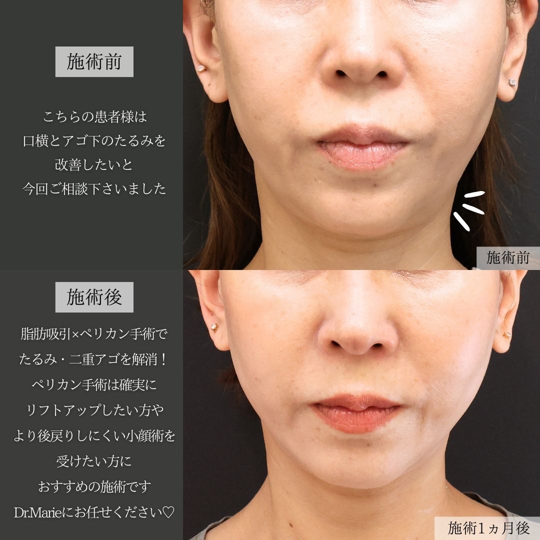 顎下の脂肪吸引/TAC式 ツヤ肌コラーゲンリフト®/フェイスリフト（切開）の症例写真 施術前後 