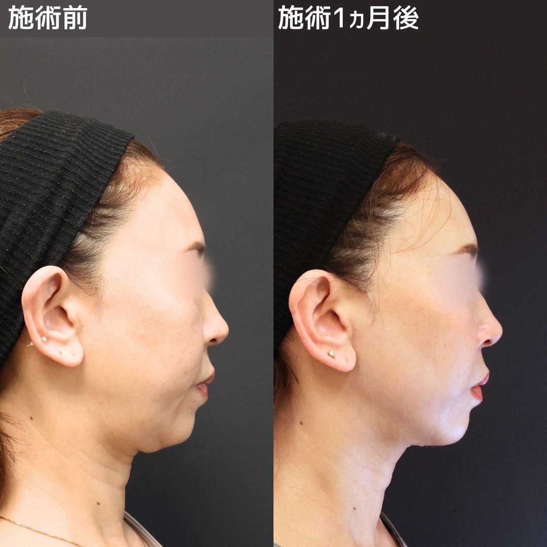 顎下の脂肪吸引/TAC式 ツヤ肌コラーゲンリフト®/フェイスリフト（切開）の症例写真 施術前後 