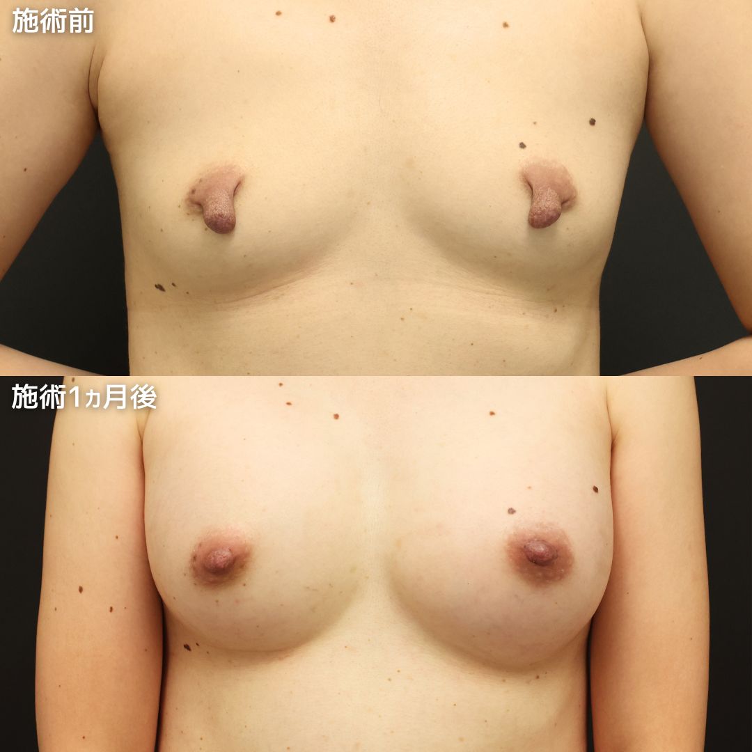 乳頭縮小術の症例写真 施術前後 