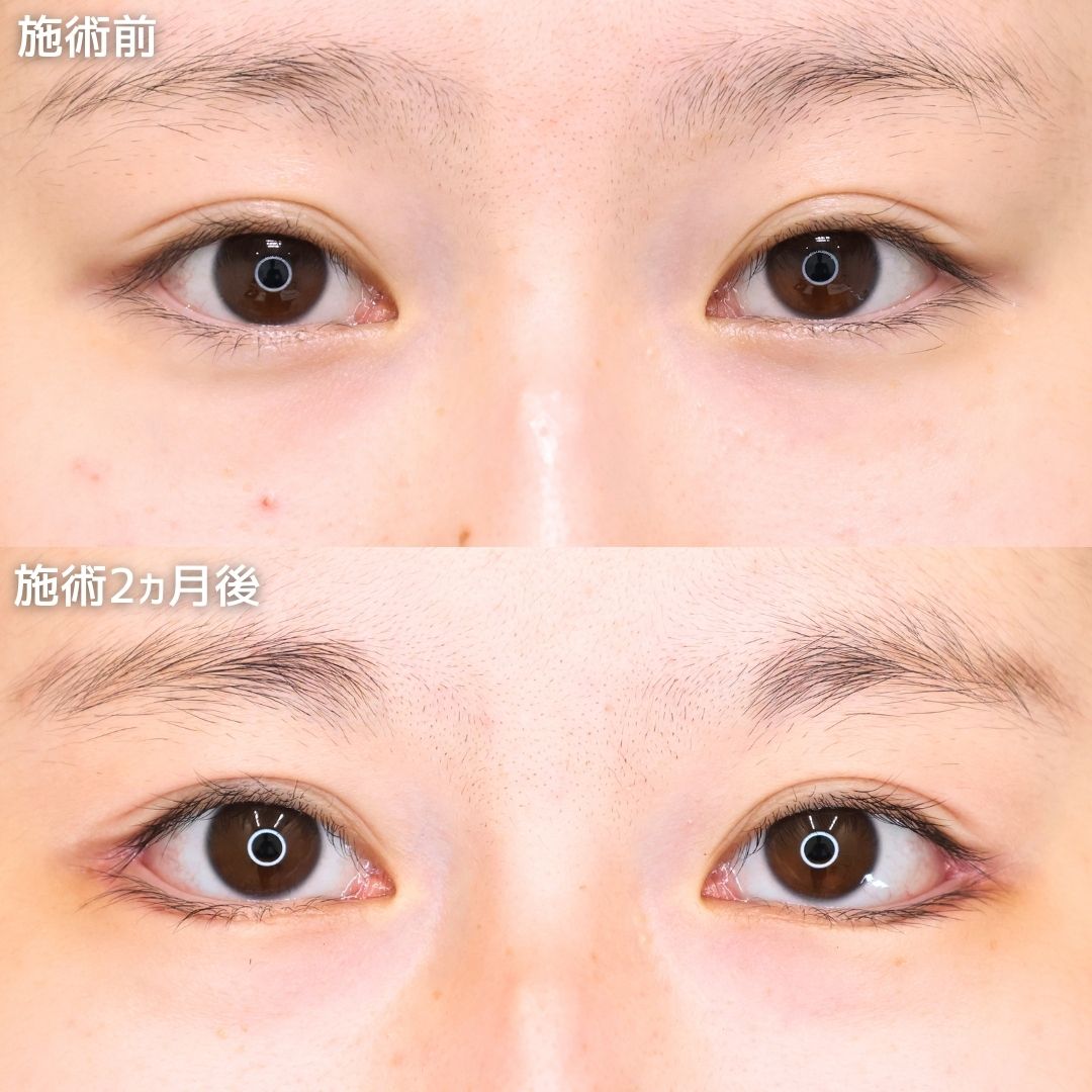 グラマラスライン（タレ目形成）/目尻靭帯移動術の症例写真 施術前後 
