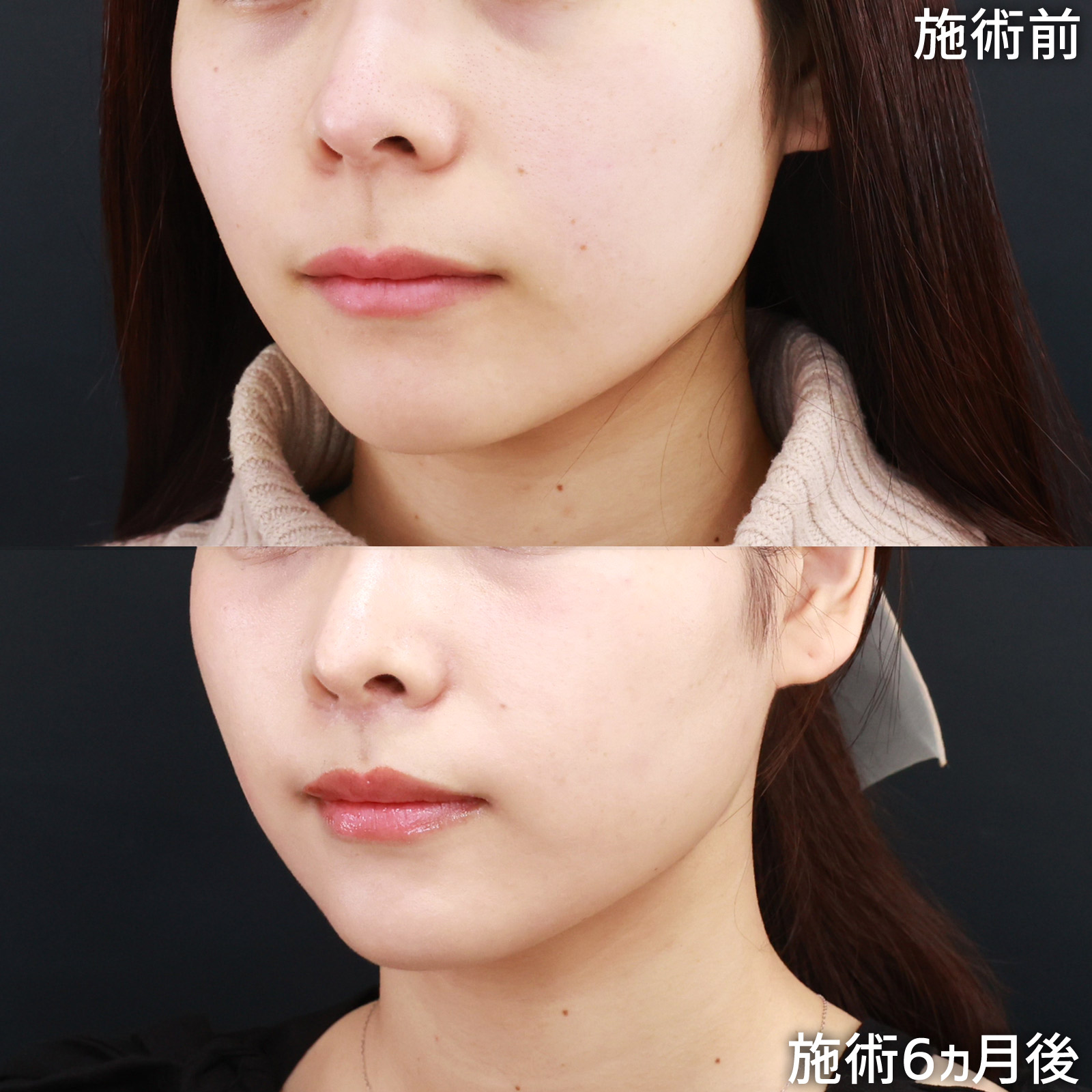 人中短縮術(リップリフト)・外側人中短縮術の症例写真 施術前後 
