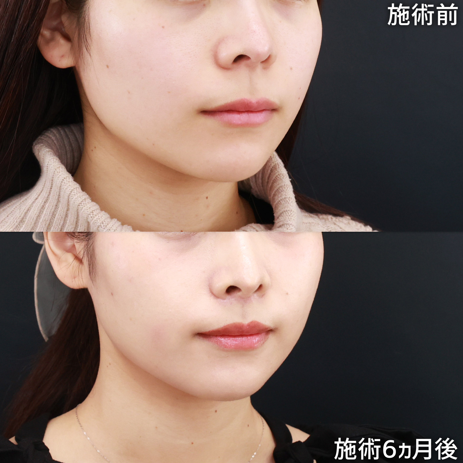 人中短縮術(リップリフト)・外側人中短縮術の症例写真 施術前後 
