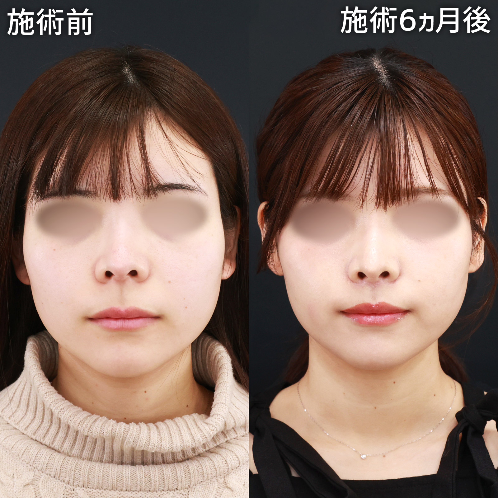 人中短縮術(リップリフト)・外側人中短縮術の症例写真 施術前後 