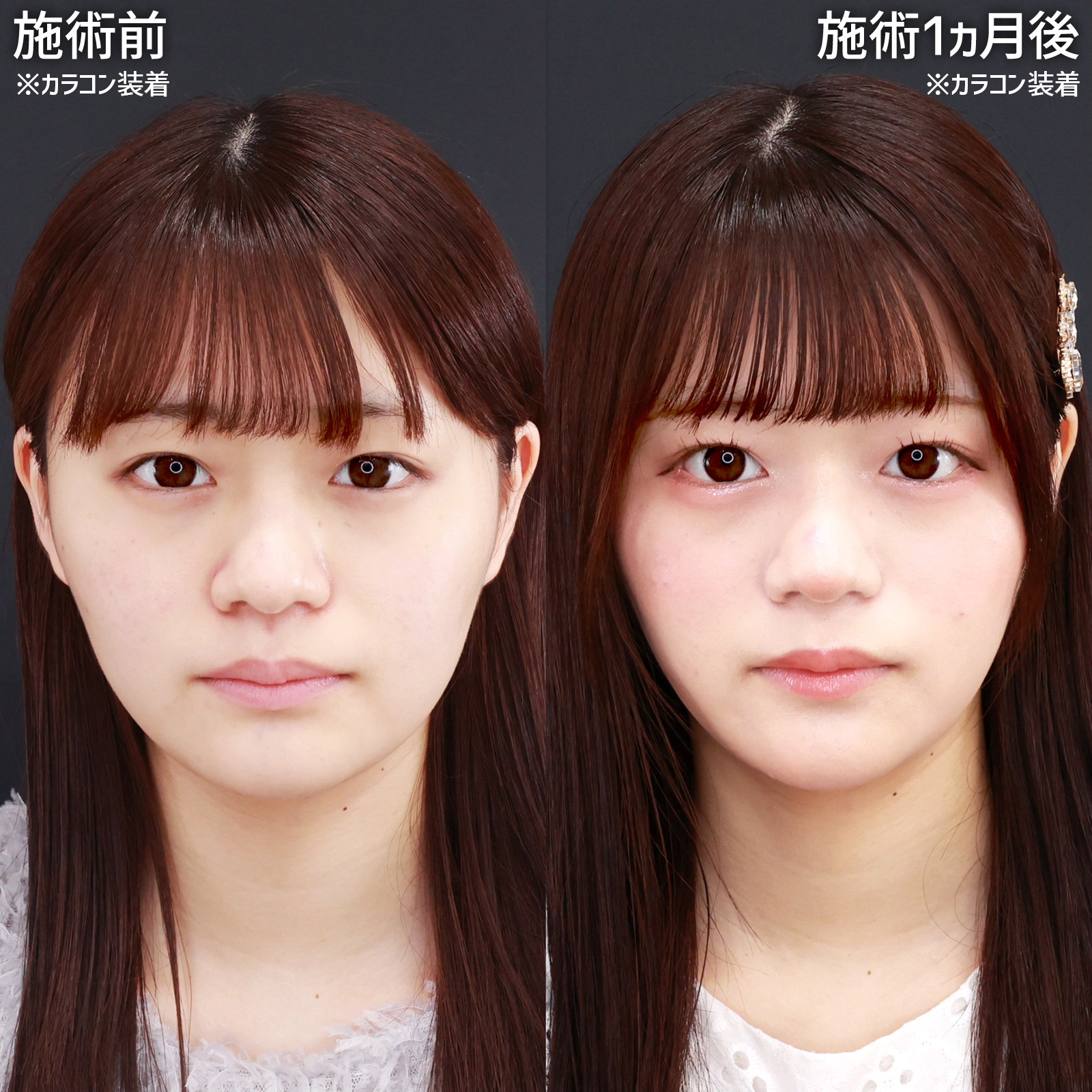 グラマラスライン（タレ目形成）/目尻切開術の症例写真 施術前後 