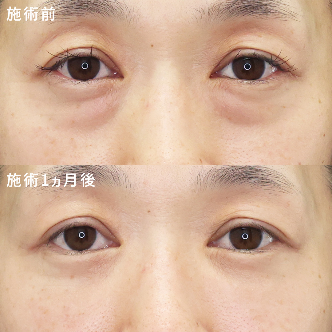 下眼瞼脱脂術（目の下のたるみ取り・目の下の脂肪ふくらみ取り）/顔の脂肪注入(コンデンスリッチフェイス)の症例写真 施術前後 