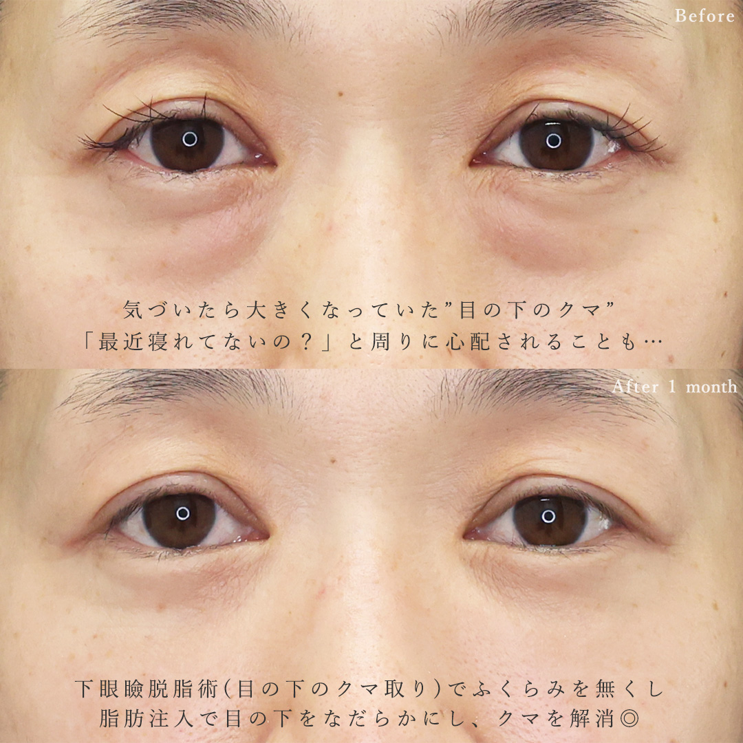 下眼瞼脱脂術（目の下のたるみ取り・目の下の脂肪ふくらみ取り）/顔の脂肪注入(コンデンスリッチフェイス)の症例写真 施術前後 