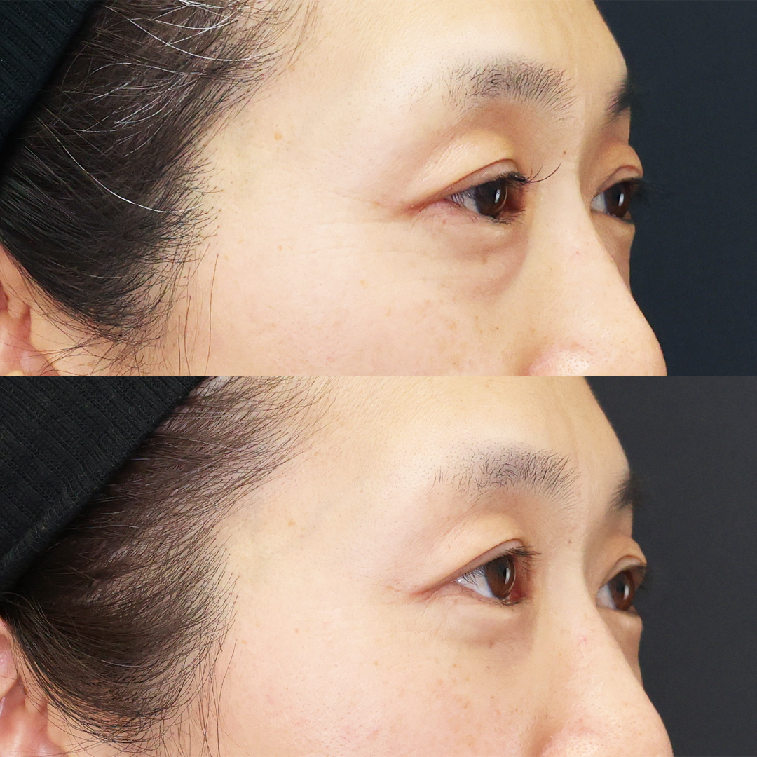 下眼瞼脱脂術（目の下のたるみ取り・目の下の脂肪ふくらみ取り）/顔の脂肪注入(コンデンスリッチフェイス)の症例写真 施術前後 