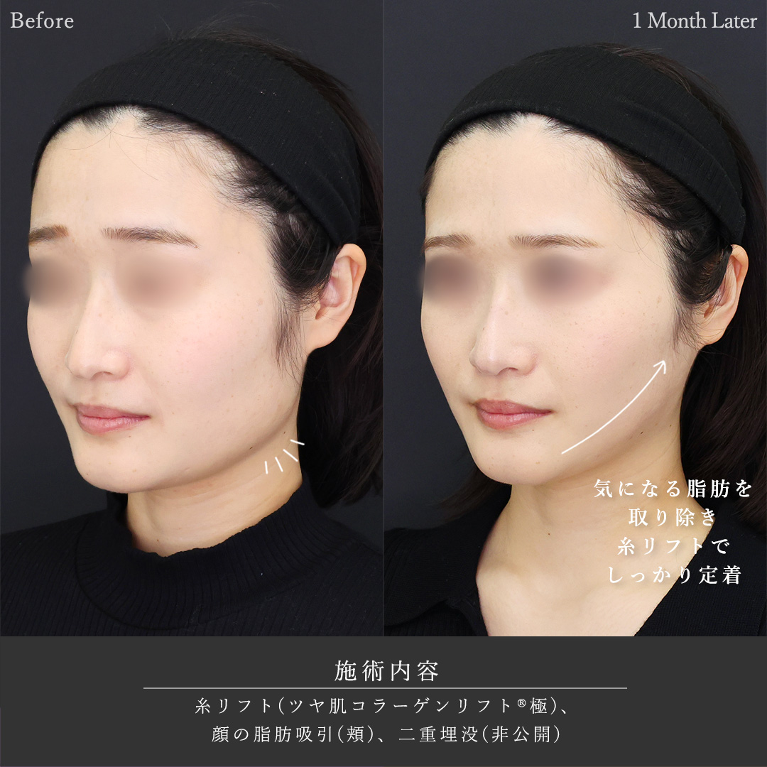 TAC式 ツヤ肌コラーゲンリフト®/顎下の脂肪吸引の症例写真 施術前後 