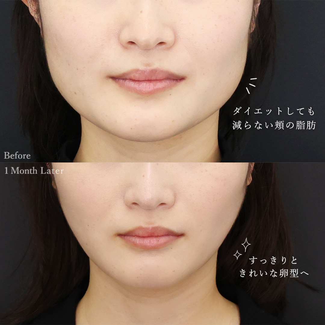 TAC式 ツヤ肌コラーゲンリフト®/顎下の脂肪吸引の症例写真 施術前後 
