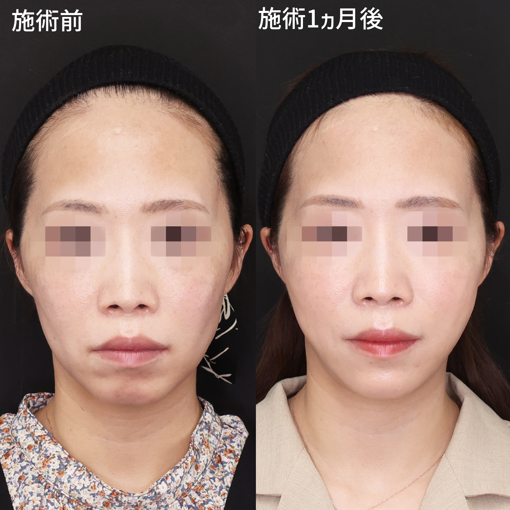 TAC式 ツヤ肌コラーゲンリフト®/顎のヒアルロン酸注射/ボトックス注射：その他の症例写真 施術前後 