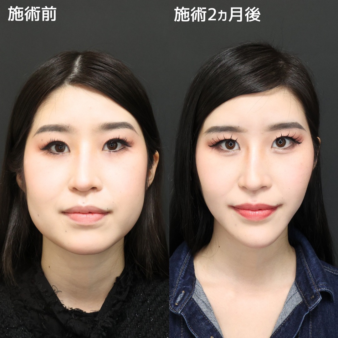 TAC式 ツヤ肌コラーゲンリフト®/バッカルファット除去/ジョールファット除去の症例写真 施術前後 