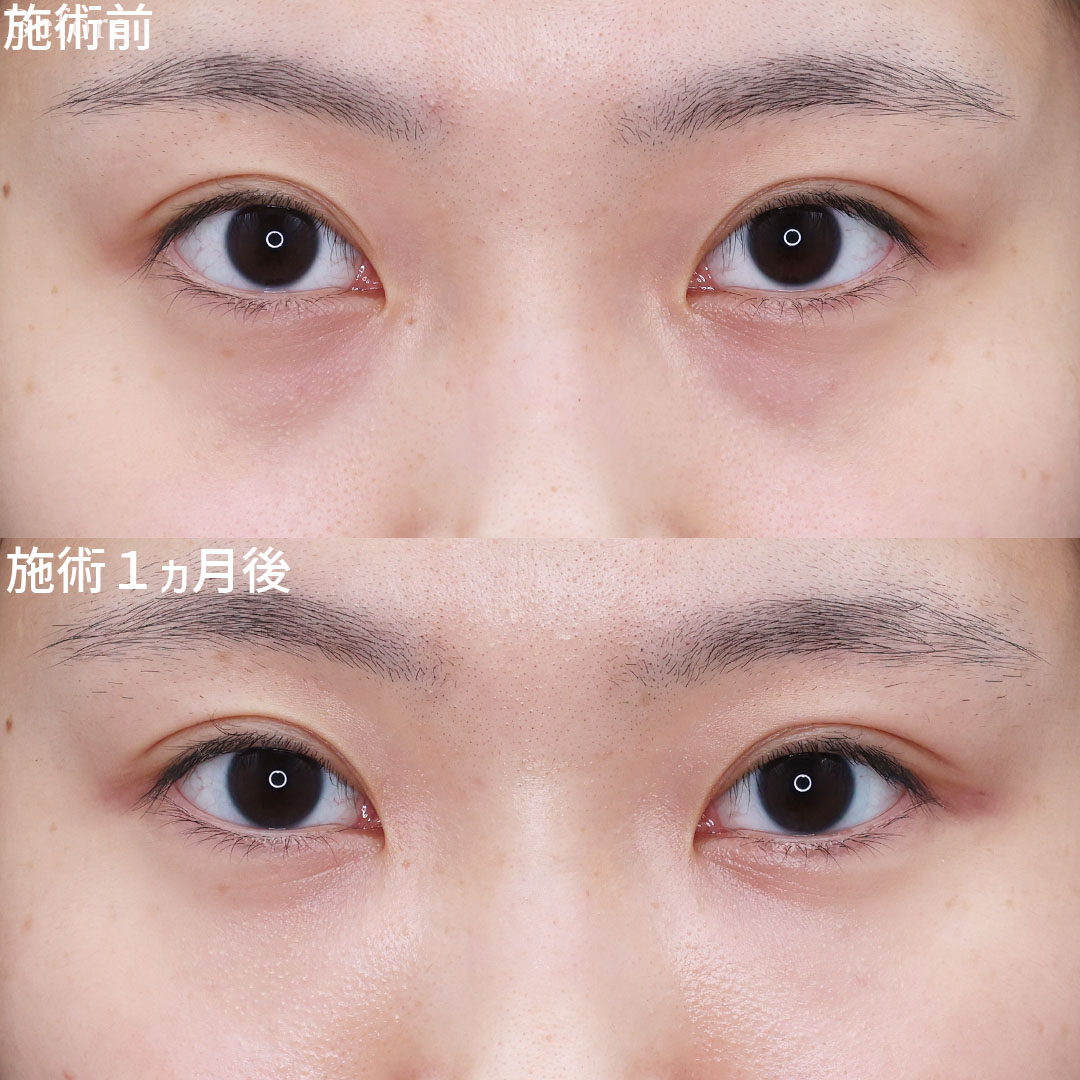 下眼瞼脱脂術（目の下のたるみ取り・目の下の脂肪ふくらみ取り）/顔の脂肪注入(コンデンスリッチフェイス)の症例写真 施術前後 