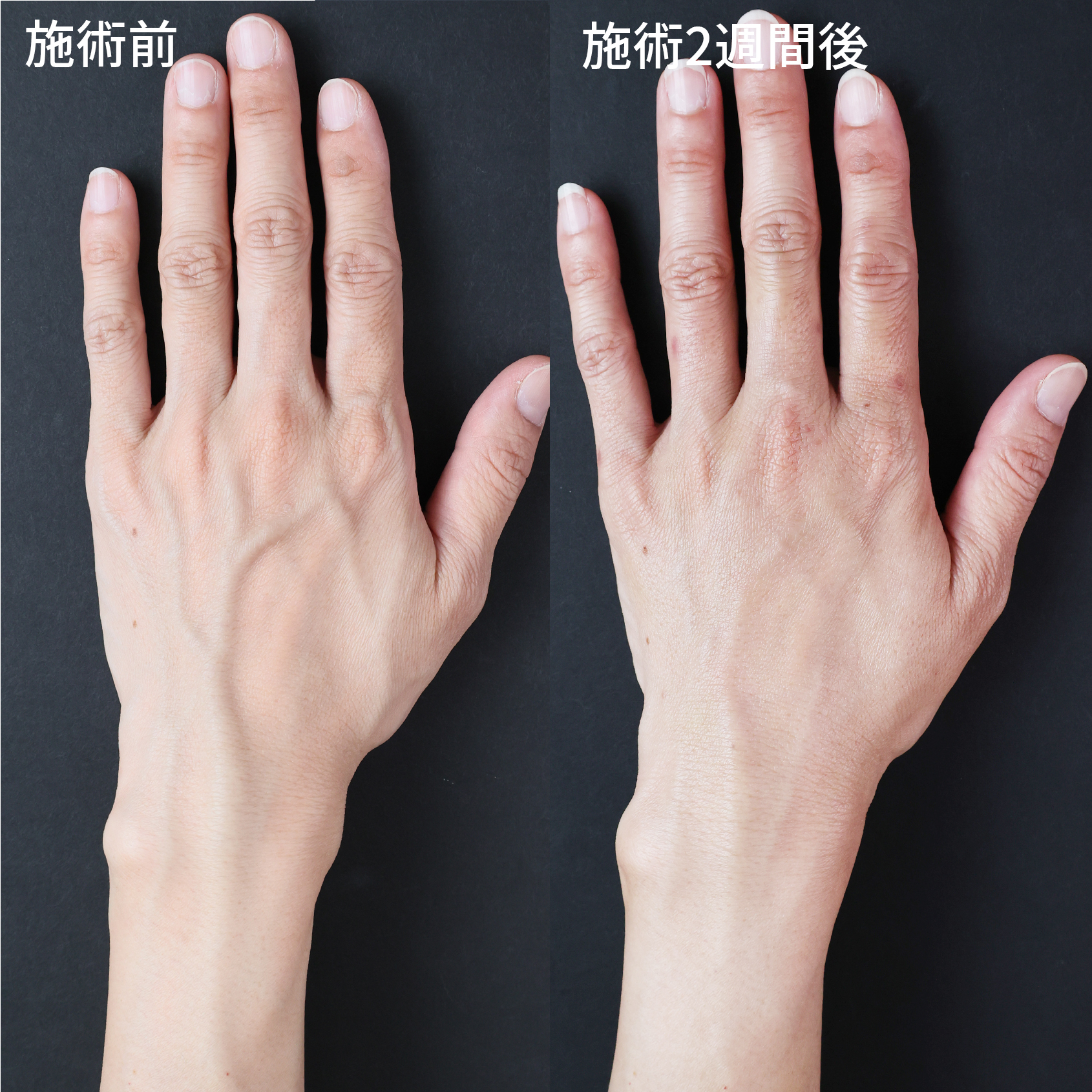 ハンドベイン（手のアンチエイジング・血管治療）の症例写真 施術前後 