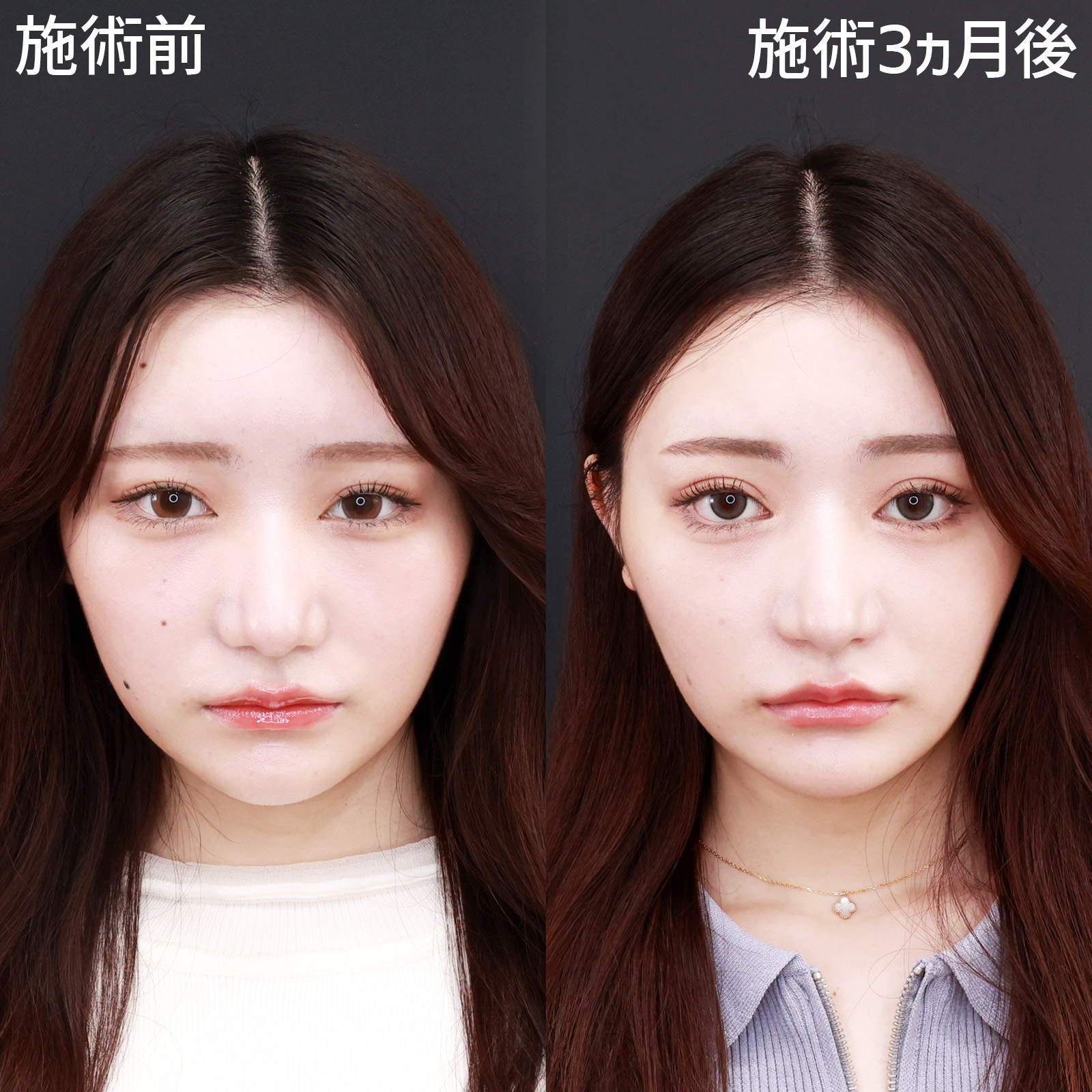 二重切開（全切開法）/グラマラスライン（タレ目形成）/目尻靭帯移動術の症例写真 施術前後 