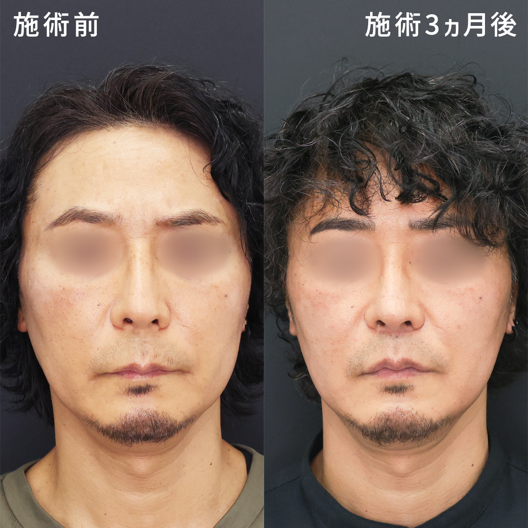 人中短縮術(リップリフト)・外側人中短縮術の症例写真 施術前後 