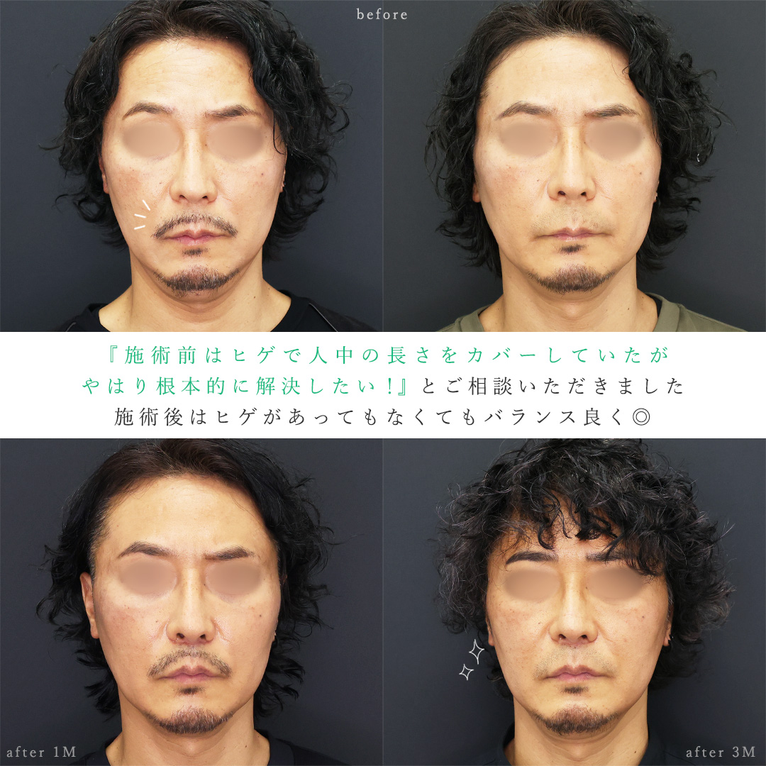 人中短縮術(リップリフト)・外側人中短縮術の症例写真 施術前後 